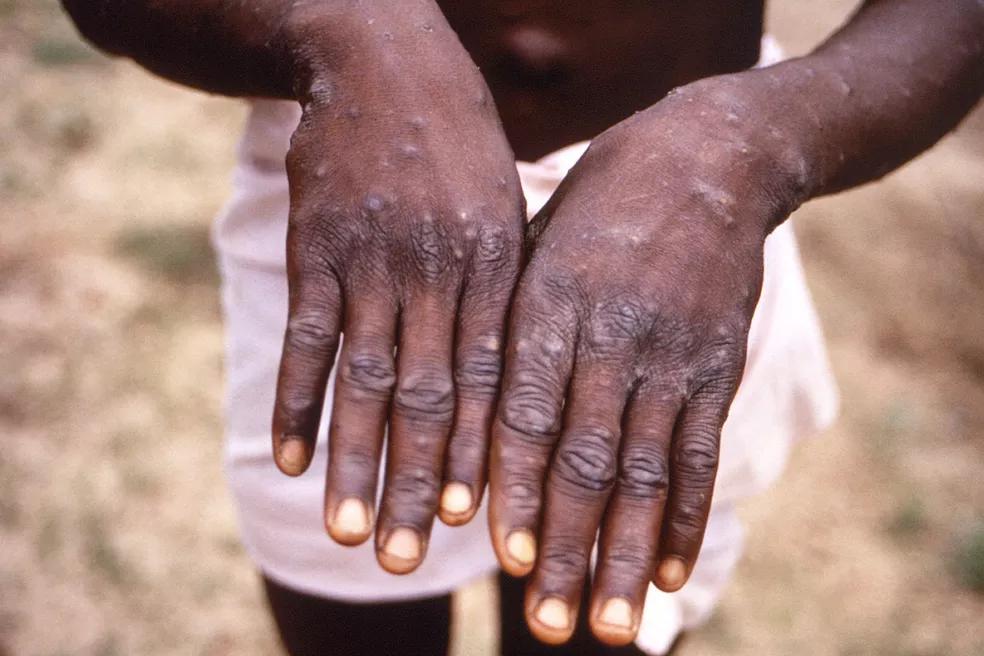 EUA, Canadá e Europa confirmam casos de varíola dos macacos e aumentam temor de novos surtos pelo mundo
